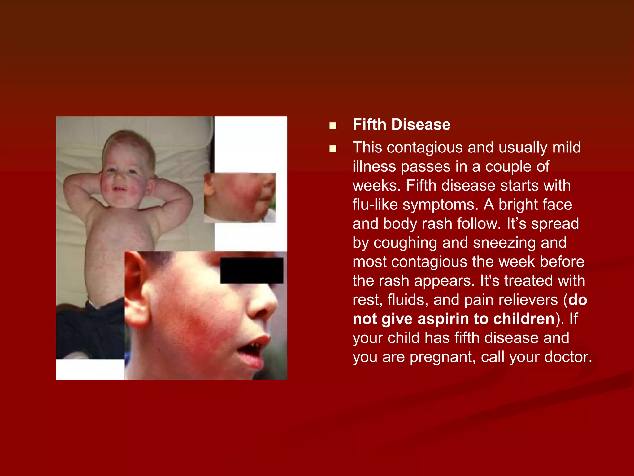 


Fifth Disease
This contagious and usually mild
illness passes in a couple of
weeks. Fifth disease starts with
flu-like symptoms. A bright face
and body rash follow. It’s spread
by coughing and sneezing and
most contagious the week before
the rash appears. It's treated with
rest, fluids, and pain relievers (do
not give aspirin to children). If
your child has fifth disease and
you are pregnant, call your doctor.

 