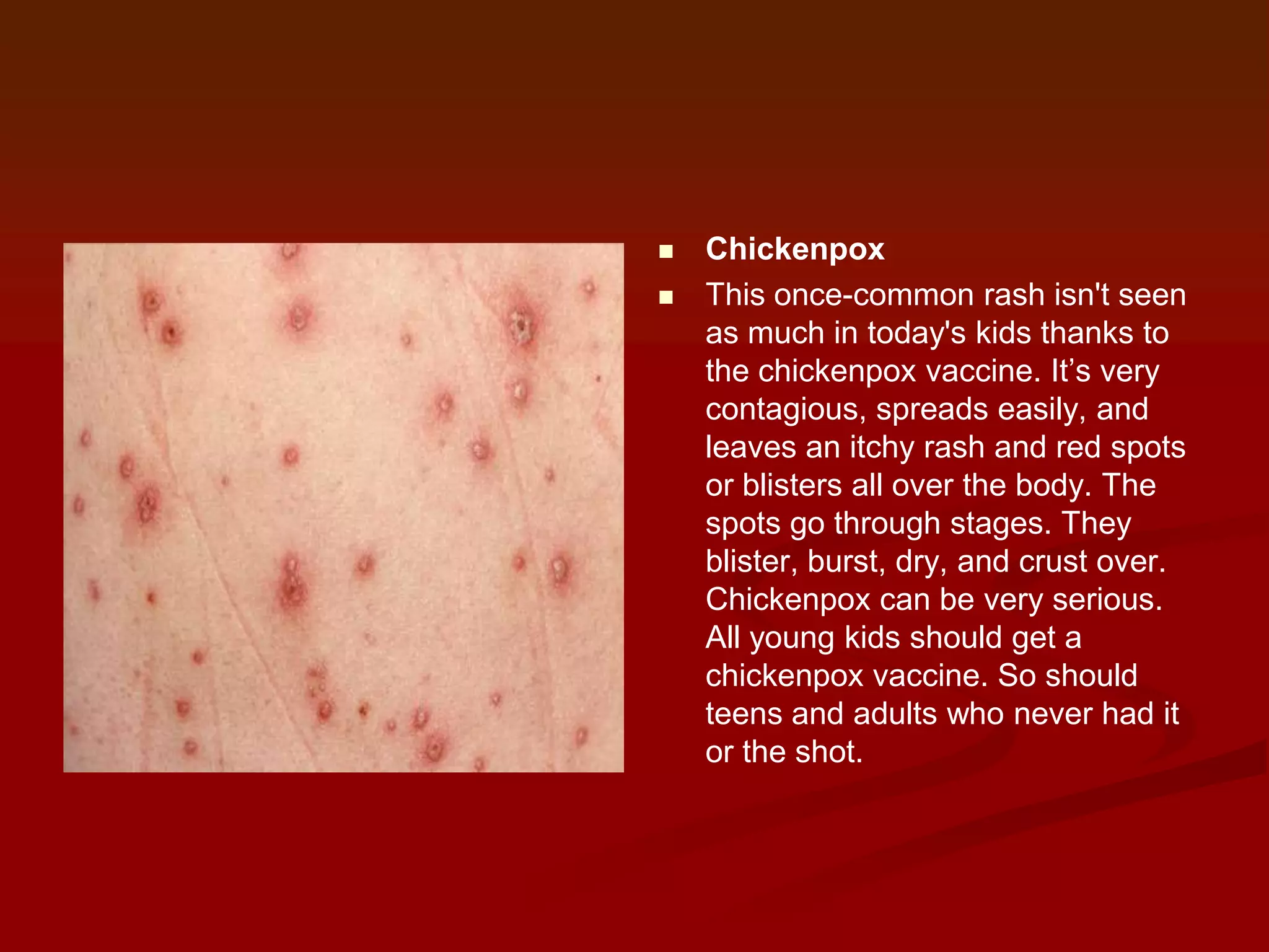 


Chickenpox
This once-common rash isn't seen
as much in today's kids thanks to
the chickenpox vaccine. It’s very
contagious, spreads easily, and
leaves an itchy rash and red spots
or blisters all over the body. The
spots go through stages. They
blister, burst, dry, and crust over.
Chickenpox can be very serious.
All young kids should get a
chickenpox vaccine. So should
teens and adults who never had it
or the shot.

 