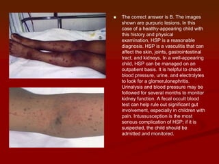 Bruising Rash evaluating a child with febrile rash | PPTX
