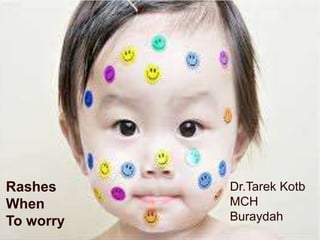 Rashes when to worry-----------?
D. TAREK SAYED
pediatric departement
MCH Buraydah

Rashes
When
To worry

Dr.Tarek Kotb
MCH
Buraydah

 