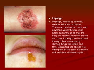 Diffuse Impetigo Rash rashes when to worry | PPTX