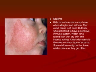 


Eczema
Kids prone to eczema may have
other allergies and asthma. The
exact cause isn't clear. But kids
who get it tend to have a sensitive
immune system. Watch for a
raised rash with dry skin and
intense itching. Atopic dermatitis is
the most common type of eczema.
Some children outgrow it or have
milder cases as they get older.

 