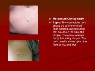 


Molluscum Contagiosum
Signs: This contagious rash
shows up as one or more
flesh-colored, raised bumps
that are about the size of a
pimple. The center of each
bump has a tiny dimple. The
rash usually shows up on the
face, arms, and legs

 