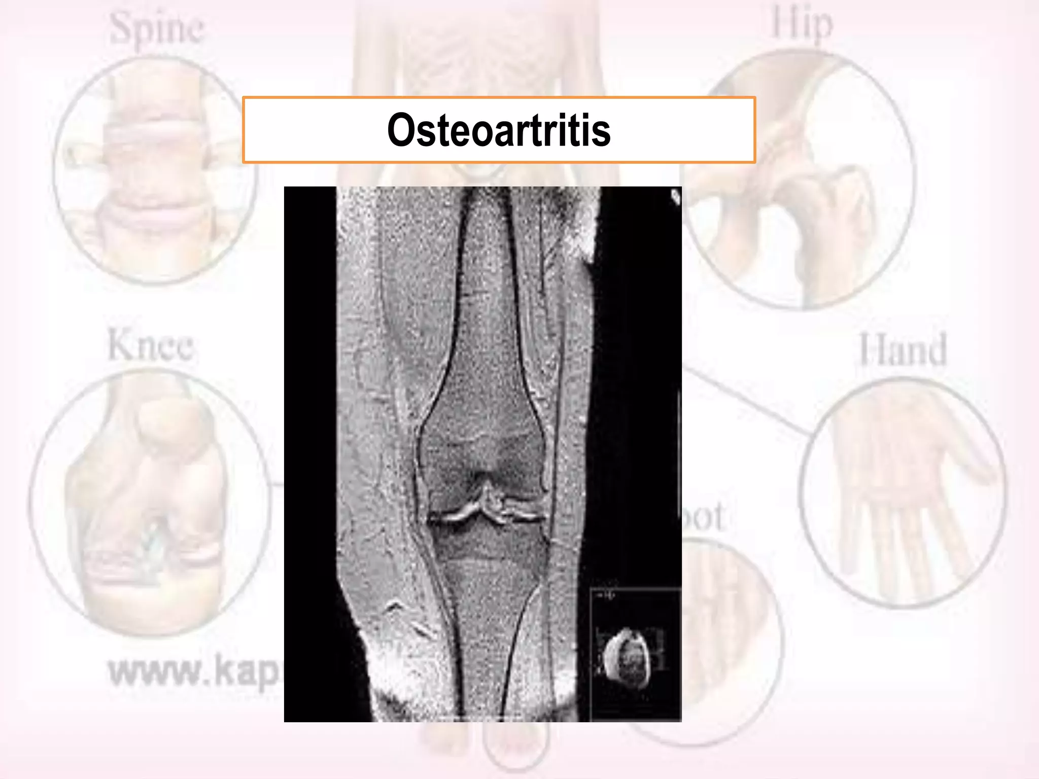 Osteoartritis

 