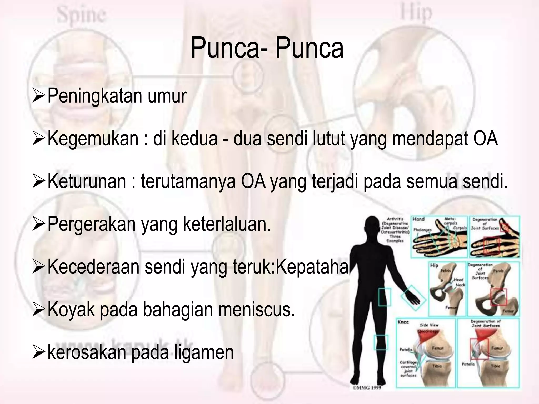 Punca- Punca
Peningkatan umur
Kegemukan : di kedua - dua sendi lutut yang mendapat OA
Keturunan : terutamanya OA yang terjadi pada semua sendi.
Pergerakan yang keterlaluan.
Kecederaan sendi yang teruk:Kepatahan tulang.

Koyak pada bahagian meniscus.
kerosakan pada ligamen

 