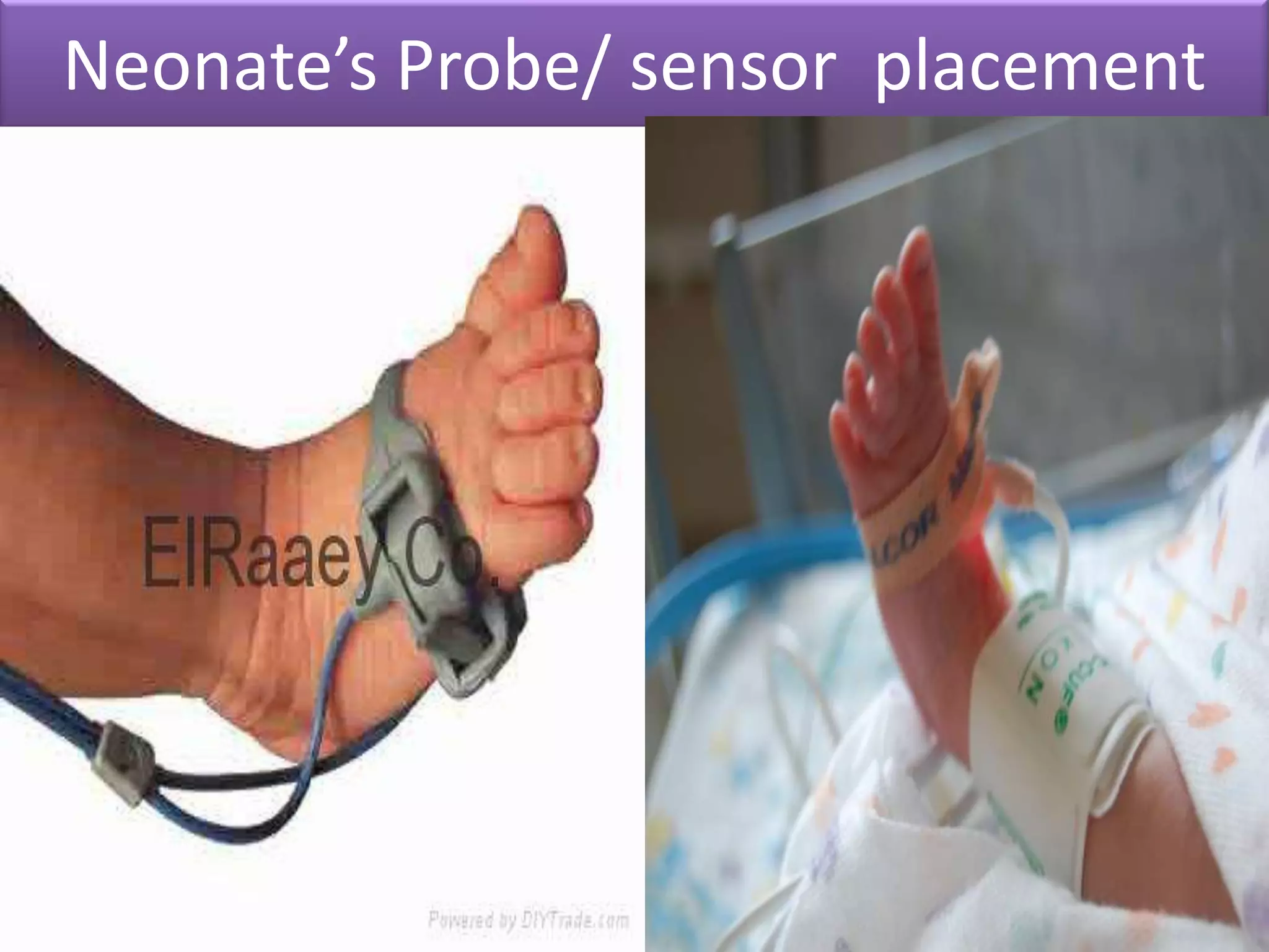 Neonate’s Probe/ sensor placement

 