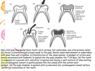 Non-vital pulp therapy⎯primary tooth. (a) A carious, but restorable, non-vital primary molar.
(b) Caries is eliminated and access made to the pulp. Gentle canal debridement is undertaken
with smal files and irrigation. (c) Disinfection of the canal system. A pledget of cotton wool
barely moistened with ledermix is sealed into the pulp chamber for 7-10 days. (d) The tooth
is reopened at a second visit, and after irrigation and drying, a soft mixture of slow-setting
zinc oxideeugenol cement is gently packed into the canals with the cotton-wool
pledget. (e) The pulp chamber is packed with accelerated zinc oxideeugenol cement before
.definitive restoration of the tooth

 