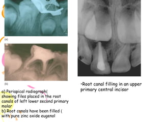 a) Periapical radiograph)
showing files placed in the root
canals of left lower second primary
molar
b) Root canals have been filled )
with pure zinc oxide eugenol

•Root canal filling in an upper
primary central incisor

 