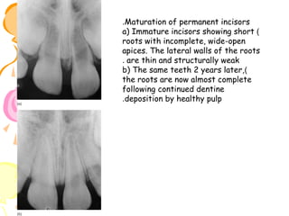 .Maturation of permanent incisors
a) Immature incisors showing short )
roots with incomplete, wide-open
apices. The lateral walls of the roots
. are thin and structurally weak
b) The same teeth 2 years later,)
the roots are now almost complete
following continued dentine
.deposition by healthy pulp

 
