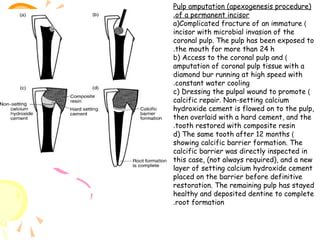Pulp amputation (apexogenesis procedure)
.of a permanent incisor
a)Complicated fracture of an immature )
incisor with microbial invasion of the
coronal pulp. The pulp has been exposed to
.the mouth for more than 24 h
b) Access to the coronal pulp and )
amputation of coronal pulp tissue with a
diamond bur running at high speed with
.constant water cooling
c) Dressing the pulpal wound to promote )
calcific repair. Non-setting calcium
hydroxide cement is flowed on to the pulp,
then overlaid with a hard cement, and the
.tooth restored with composite resin
d) The same tooth after 12 months )
showing calcific barrier formation. The
calcific barrier was directly inspected in
this case, (not always required), and a new
layer of setting calcium hydroxide cement
placed on the barrier before definitive
restoration. The remaining pulp has stayed
healthy and deposited dentine to complete
.root formation

 