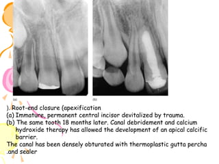 (. Root-end closure (apexification
(a) Immature, permanent central incisor devitalized by trauma.
(b) The same tooth 18 months later. Canal debridement and calcium
hydroxide therapy has allowed the development of an apical calcific
barrier.
The canal has been densely obturated with thermoplastic gutta percha
.and sealer

 