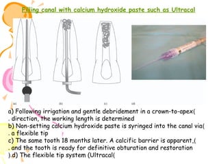 Filling canal with calcium hydroxide paste such as Ultracal

a) Following irrigation and gentle debridement in a crown-to-apex )
. direction, the working length is determined
b) Non-setting calcium hydroxide paste is syringed into the canal via )
. a flexible tip
c) The same tooth 18 months later. A calcific barrier is apparent, )
. and the tooth is ready for definitive obturation and restoration
(.d) The flexible tip system (Ultracal)

 
