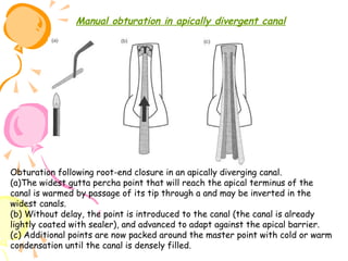 Manual obturation in apically divergent canal

Obturation following root-end closure in an apically diverging canal.
(a)The widest gutta percha point that will reach the apical terminus of the
canal is warmed by passage of its tip through a and may be inverted in the
widest canals.
(b) Without delay, the point is introduced to the canal (the canal is already
lightly coated with sealer), and advanced to adapt against the apical barrier.
(c) Additional points are now packed around the master point with cold or warm
condensation until the canal is densely filled.

 