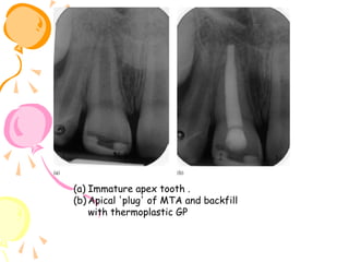 (a) Immature apex tooth .
(b) Apical 'plug' of MTA and backfill
with thermoplastic GP

 