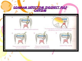 DIAGRAM DEPICTING INDIRECT PULP
CAPPING

 