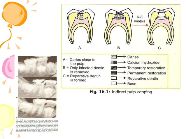 pulp therapy in pediatric dentistry | PPT