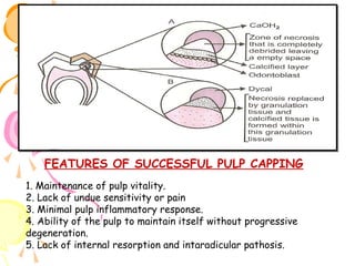 FEATURES OF SUCCESSFUL PULP CAPPING
1. Maintenance of pulp vitality.
2. Lack of undue sensitivity or pain
3. Minimal pulp inflammatory response.
4. Ability of the pulp to maintain itself without progressive
degeneration.
5. Lack of internal resorption and intaradicular pathosis.

 