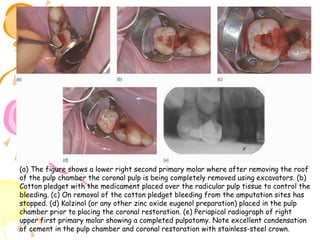 (a) The figure shows a lower right second primary molar where after removing the roof
of the pulp chamber the coronal pulp is being completely removed using excavators. (b)
Cotton pledget with the medicament placed over the radicular pulp tissue to control the
bleeding. (c) On removal of the cotton pledget bleeding from the amputation sites has
stopped. (d) Kalzinol (or any other zinc oxide eugenol preparation) placed in the pulp
chamber prior to placing the coronal restoration. (e) Periapical radiograph of right
upper first primary molar showing a completed pulpotomy. Note excellent condensation
of cement in the pulp chamber and coronal restoration with stainless-steel crown.

 