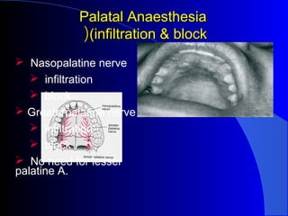 Infiltration - Palate
 Nerves
 Terminal branches - Greater Palatine nerve
 Nasopalatine nerve
 Area
 Palatal soft tis...