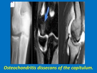 Osteochondritis dissecans of the capitulum.
 