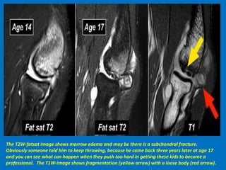 The T2W-fatsat image shows marrow edema and may be there is a subchondral fracture.
Obviously someone told him to keep throwing, because he came back three years later at age 17
and you can see what can happen when they push too hard in getting these kids to become a
professional. The T1W-image shows fragmentation (yellow arrow) with a loose body (red arrow).
 