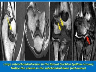 Large osteochondral lesion in the lateral trochlea (yellow arrows).
Notice the edema in the subchondral bone (red arrow).
 