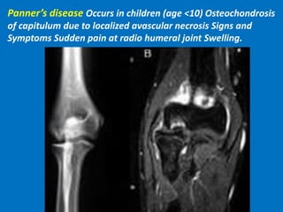 Panner’s disease Occurs in children (age <10) Osteochondrosis
of capitulum due to localized avascular necrosis Signs and
Symptoms Sudden pain at radio humeral joint Swelling.
 