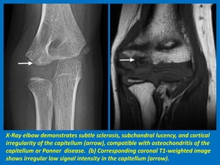 X-Ray elbow demonstrates subtle sclerosis, subchondral lucency, and cortical
irregularity of the capitellum (arrow), compatible with osteochondritis of the
capitellum or Panner disease. (b) Corresponding coronal T1-weighted image
shows irregular low signal intensity in the capitellum (arrow).
 