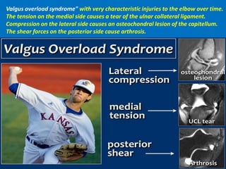 Valgus overload syndrome" with very characteristic injuries to the elbow over time.
The tension on the medial side causes a tear of the ulnar collateral ligament.
Compression on the lateral side causes an osteochondral lesion of the capitellum.
The shear forces on the posterior side cause arthrosis.
 