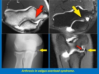 Arthrosis in valgus overload syndrome.
 