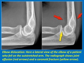 Elbow dislocation: Here a lateral view of the elbow of a patient
who fell on the outstretched arm. The radiograph shows joint
effusion (red arrows) and a coronoid fracture (yellow arrow).
 