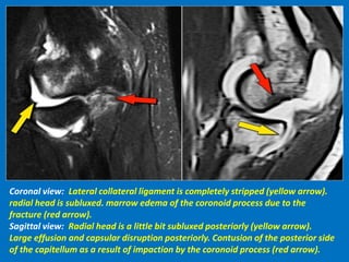 Coronal view: Lateral collateral ligament is completely stripped (yellow arrow).
radial head is subluxed. marrow edema of the coronoid process due to the
fracture (red arrow).
Sagittal view: Radial head is a little bit subluxed posteriorly (yellow arrow).
Large effusion and capsular disruption posteriorly. Contusion of the posterior side
of the capitellum as a result of impaction by the coronoid process (red arrow).
 