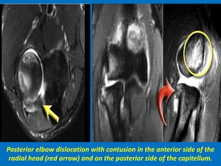 Posterior elbow dislocation with contusion in the anterior side of the
radial head (red arrow) and on the posterior side of the capitellum.
 
