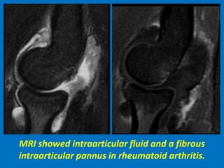 MRI showed intraarticular fluid and a fibrous
intraarticular pannus in rheumatoid arthritis.
 