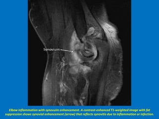 Elbow inflammation with synovuim enhancement. A contrast-enhanced T1-weighted image with fat
suppression shows synovial enhancement (arrow) that reflects synovitis due to inflammation or infection.
 