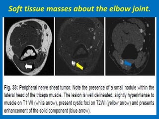 Soft tissue masses about the elbow joint.
 