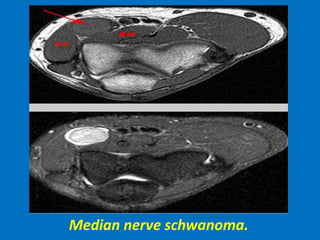 Median nerve schwanoma.
 