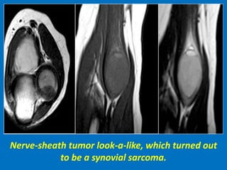 Nerve-sheath tumor look-a-like, which turned out
to be a synovial sarcoma.
 