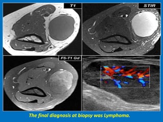 The final diagnosis at biopsy was Lymphoma.
 