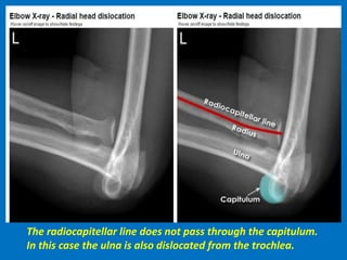 The radiocapitellar line does not pass through the capitulum.
In this case the ulna is also dislocated from the trochlea.
 