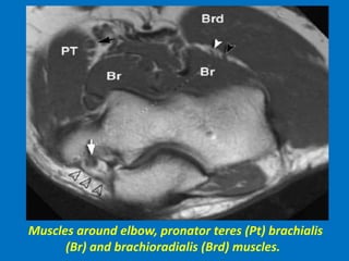 Muscles around elbow, pronator teres (Pt) brachialis
(Br) and brachioradialis (Brd) muscles.
 