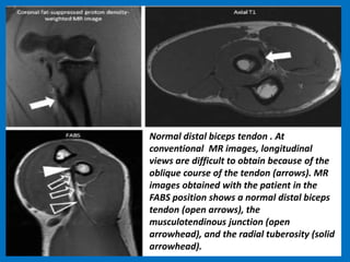 Normal distal biceps tendon . At
conventional MR images, longitudinal
views are difficult to obtain because of the
oblique course of the tendon (arrows). MR
images obtained with the patient in the
FABS position shows a normal distal biceps
tendon (open arrows), the
musculotendinous junction (open
arrowhead), and the radial tuberosity (solid
arrowhead).
 