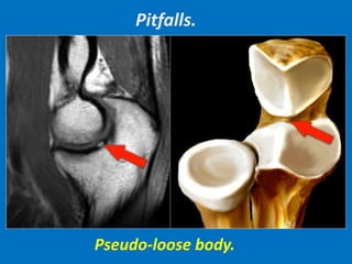 Pseudo-loose body.
Pitfalls.
 