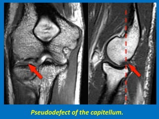 Pseudodefect of the capitellum.
 