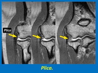 Plica.
 