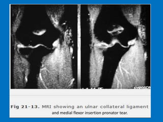 and medial flexor insertion pronator tear.
 