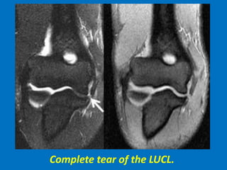 Complete tear of the LUCL.
 
