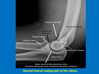Normal lateral radiograph of the elbow.
 
