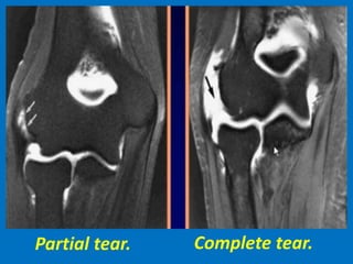 Partial tear. Complete tear.
 