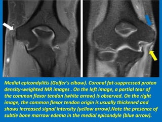 Medial epicondylitis (Golfer's elbow). Coronal fat-suppressed proton
density-weighted MR images . On the left image, a partial tear of
the common flexor tendon (white arrow) is observed. On the right
image, the common flexor tendon origin is usually thickened and
shows increased signal intensity (yellow arrow).Note the presence of
subtle bone marrow edema in the medial epicondyle (blue arrow).
 